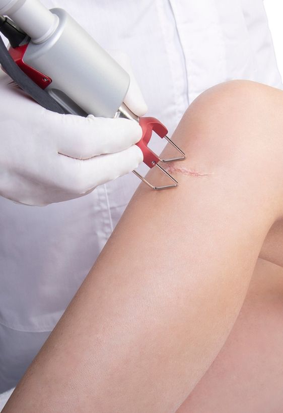 Duo-Glide-Derm-Trattamenti-DEKA-LASER